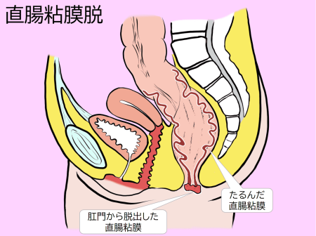 直腸粘膜脱患者の骨盤断面図