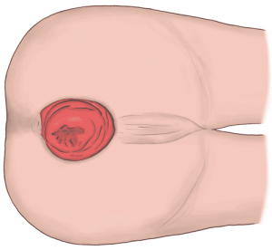 直腸脱患者の会陰部