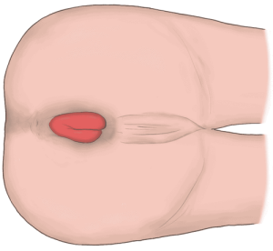 粘膜脱患者の会陰部