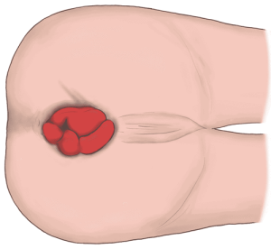 脱肛(全周のいぼ痔)患者の会陰部