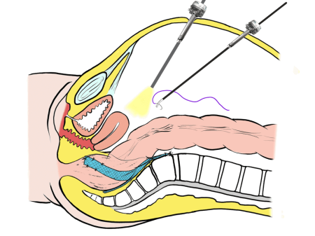 筆者の腹腔鏡手術模式図