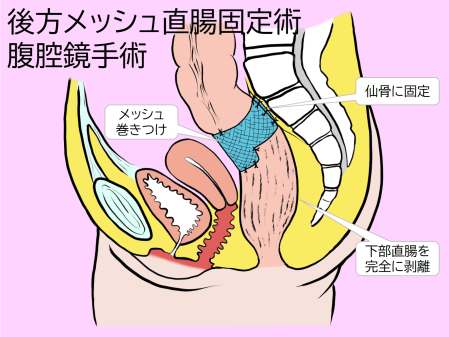 後方メッシュ直腸固定術模式図