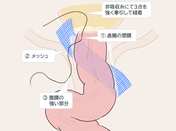 直腸左側の牽引