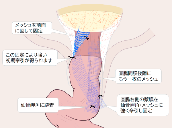 メッシュの固定と直腸右側の牽引
