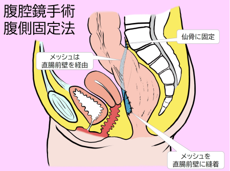 腹側固定法模式図