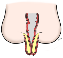 直腸脱の断面図