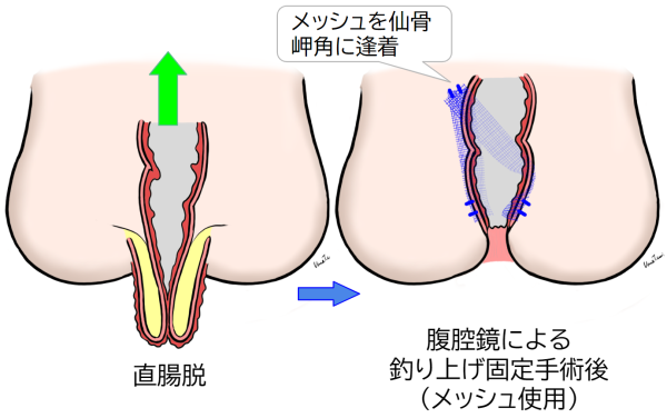 経腹手術