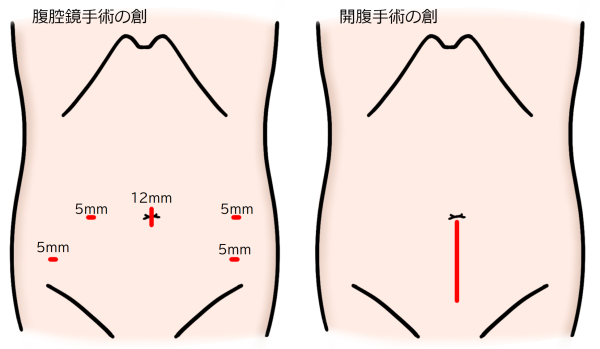 経腹手術の手術創